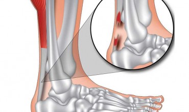 Aşil Tendon Yaralanması