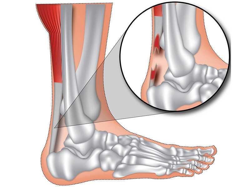 Aşil Tendon Yaralanması