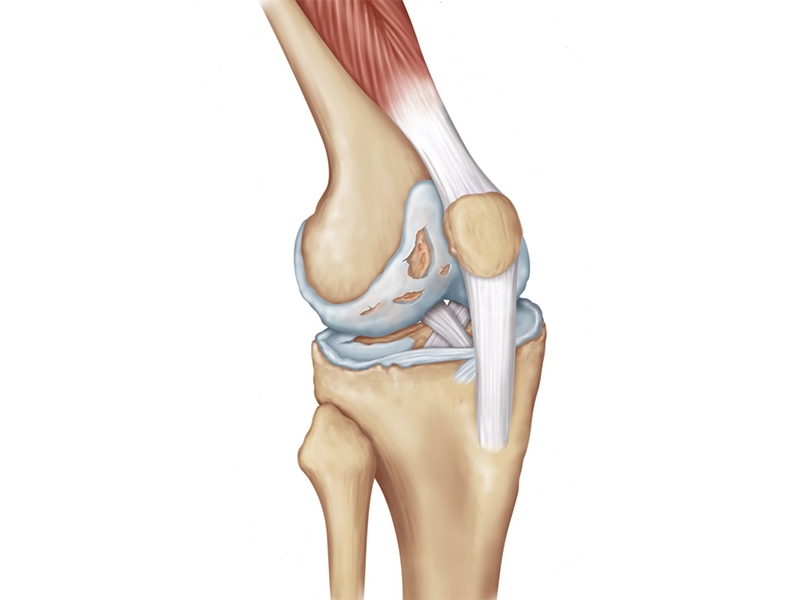 Diz Eklemi Kıkırdak Aşınması