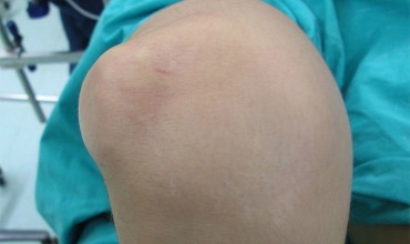 Diz Kapağı &Ccedil;ıkığı (Patella Dislokasyonu)