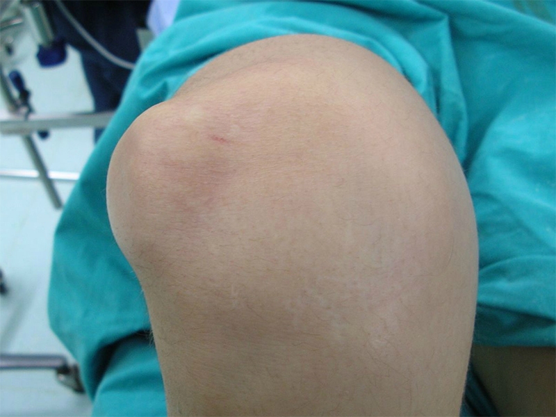 Diz Kapağı &Ccedil;ıkığı (Patella Dislokasyonu)