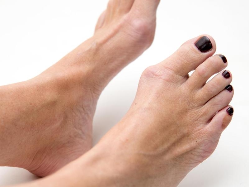 Ayak Baş Parmak &Ccedil;ıkıntısı (Halluks Valgus)