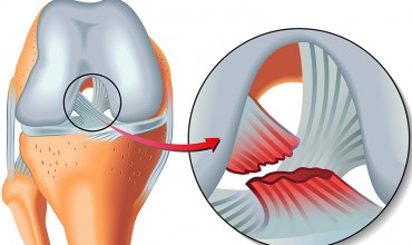 &Ouml;n &Ccedil;apraz Bağ Yaralanmaları