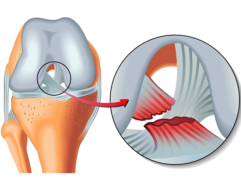 &Ouml;n &Ccedil;apraz Bağ Yaralanmaları